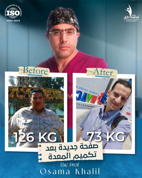 هل يمكن ان يتحسن ارتجاع المرىء بعد التكميم مع مرور الوقت ؟